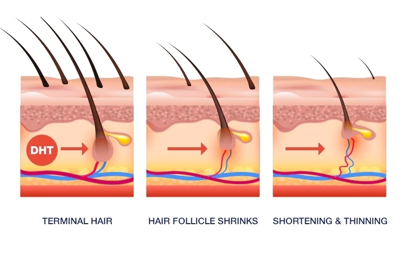 dht and hair loss image1 reequil1722586050 - 헤어온의원