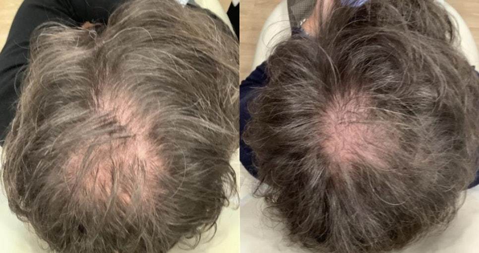 hair restoration 50 top of head det1723618882 - 헤어온의원