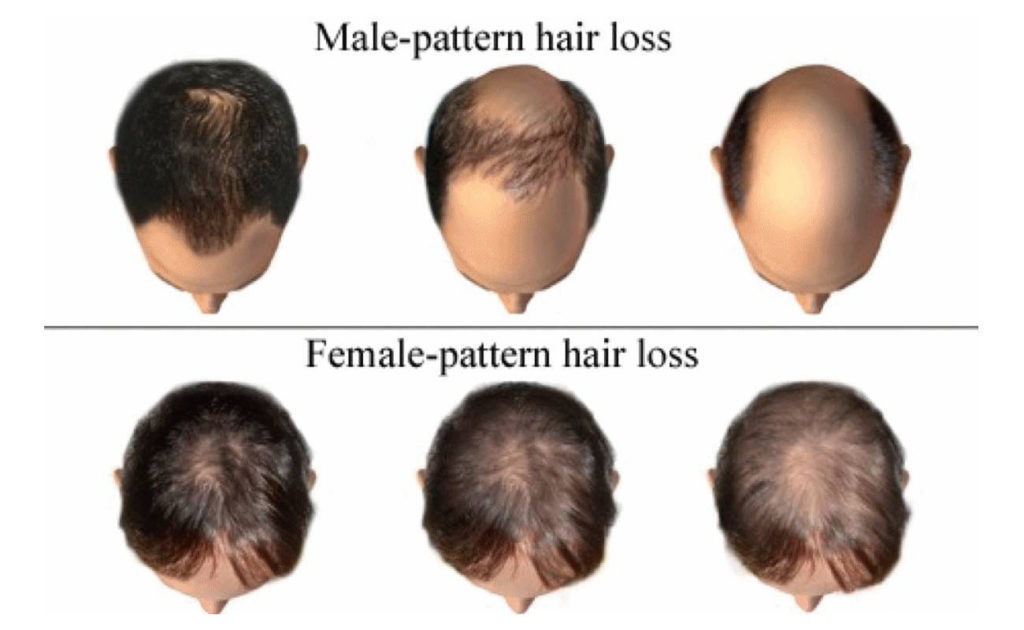male pattern hair loss - 헤어온의원