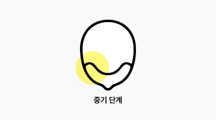 탈모약과 함께 두피·주사 치료를 병행하여 남아 있는 모낭의 반응을 최대한 끌어올림