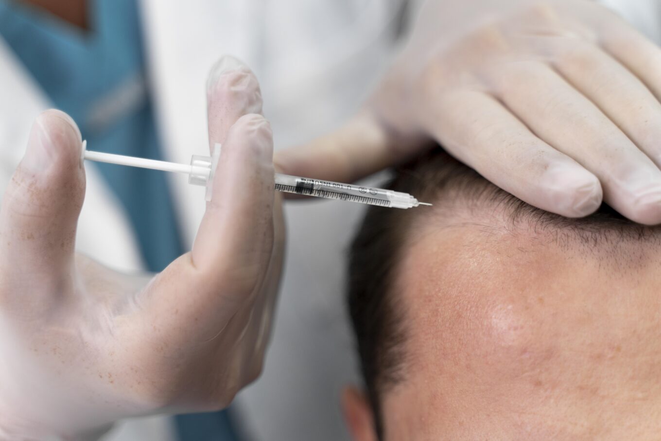 adult male doing follicular unit extraction - 헤어온의원