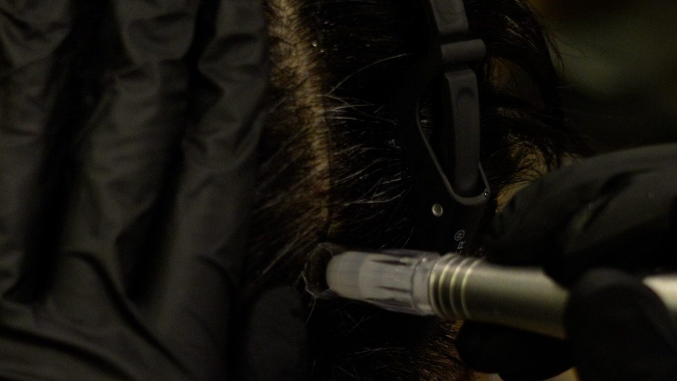 When are follicle-strengthening injections used?